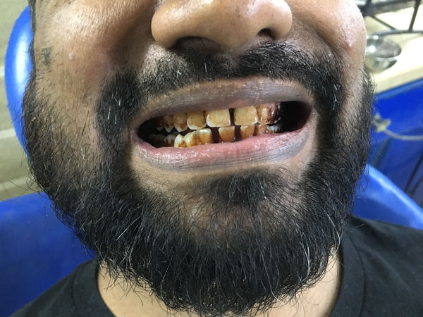 Before using Dr. Dental